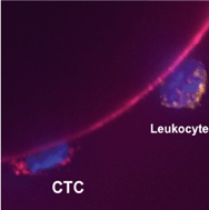 Graphical abstract: Isolation of breast cancer and gastric cancer circulating tumor cells by use of an anti HER2-based microfluidic device