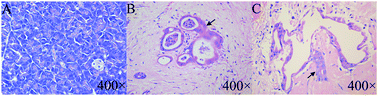 Graphical abstract: Metabonomic alterations from pancreatic intraepithelial neoplasia to pancreatic ductal adenocarcinoma facilitate the identification of biomarkers in serum for early diagnosis of pancreatic cancer