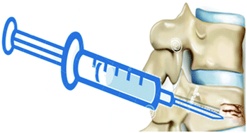 Graphical abstract: Preparation and characterisation of an innovative injectable calcium sulphate based bone cement for vertebroplasty application