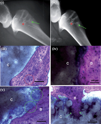 
          In vivo response with the nanocomposite bone cement in sheep. (i) X-rays (left tibia) immediately after surgery and (ii) after 12 weeks. Invasion of the marrow region (indicated by the asterisk) and restoration of the cavities is observed. There are no inflammatory reactions in the surrounding tissues after 12 weeks. (iii) An image of Giemsa surface staining of the specimens at 12 weeks after implantation shows excellent contact between the nanocomposite PMMA-HA-CNT bioactive-bone cement (C) and the bone tissue (B) with no fibrous tissues and no inflammatory cell infiltration. Oteocytes, which are indicated by the red dotted circle regions, are observed. (iv) An image of Giemsa surface staining focusing on the interface between the nanocomposite bioactive bone cement and the tissue (C) and the bone tissue (B), which is very favourable. (v) An image of Giemsa surface staining focusing revealing multinuclear osteoclast-like cells covering the surface of the bone cement, as indicated by the green dotted circles; there was no direct contact between bioactive-bone cement (C) and bone tissue (B) generally observed. (vi) An image of Giemsa surface staining focusing showing that the new bone (B) clearly enters into the pores of the bone cement (C), as indicated by the green dotted arrow.