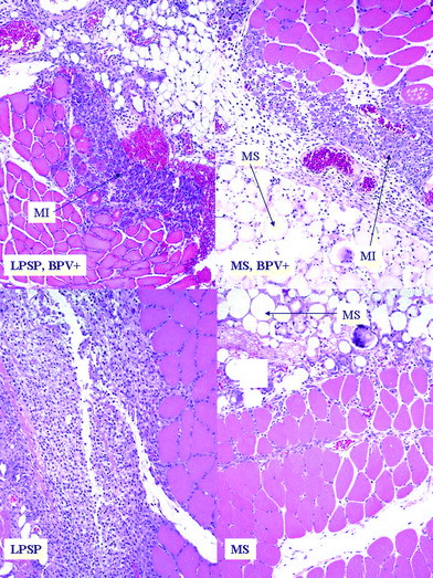 
          Inflammatory response and reaction of muscle 4 days after injection. Reaction to PLGA microspheres (MS) and lipid-protein-sugar particles (LPSPs) with bupivacaine (BPV+) showed inflammation and muscle injury (MI), whereas particles without bupivacaine showed no muscle fiber injury, and less inflammation adjacent to the pocket of particles. Original magnification is 10× in all frames. Individual LPSPs cannot easily be discerned in these views. (Biocompatibility of lipid-protein-sugar particles containing bupivacaine in the epineurium, J. Biomed. Mater. Res., Part A, 2002, 59(3), 450–459. Copyright 2002 Wiley Periodicals, Inc., A Wiley Company; reprinted with permission of John Wiley & Sons, Inc.)