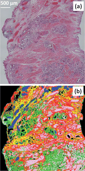 (a) Visible micrograph of a prostate tissue section stained with haematoxylin and eosin (H&E). (b) False colour image based upon FTIR spectroscopic image of a serial section of the same prostate tissue sample. Colour code as follows: blue = blood, green = epithelium, pink = smooth muscle, red = fibrous muscle, yellow = mixed stroma.