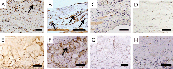 Staining of cellular infiltrate of implanted samples. Anti-rat vWF staining characterized endothelialization of 1 month collagen (A), 3 month collagen (B), 1 month Permacol™ (E) and 3 month Permacol™ (F) samples. Arrows point to circular vessel like structures. Monocyte/macrophage marker CD68 staining of 1 month collagen (C), 3 month collagen (D), 1 month Permacol™ (G) and 3 month Permacol™ (H). Total number of CD68+ nuclei decreases more in collagen implants compared to Permacol implants at 3 months. Scale bar 100 μm.