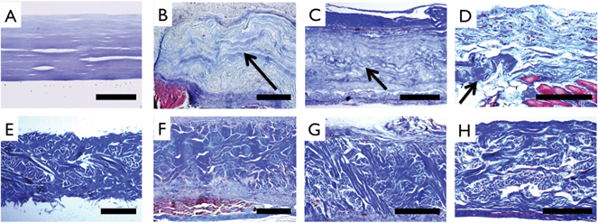 Extracellular matrix staining (Masson's Trichrome) of unimplanted and implanted samples. Collagen (A) and control (E) patches prior to implant show uniform thickness and distinct morphology. For collagen implants, wavy morphology collagen (arrows) is noted above muscle (red) and adjoining highly cellularized peritoneal layer at 1 month (B), is clearly delineated in the center of the recellularized implant at 2 months (C), and is seen in isolated pockets at 3 months (D). Control implants can be clearly distinguished from host tissue at 1 month (F), 2 months (G) and 3 months (H), resembling preimplant structure and morphology. Scale bar A–D: 200 μm and E–H: 500 μm.